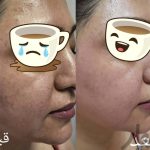 فیشال ضدجوش ضدلک،مزووایت کرمپودردائم،درماپلنینگ