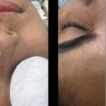 فیشال ضدجوش ضدلک،مزووایت کرمپودردائم،درماپلنینگ