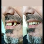 دندان سازی مصنوعی طرح لمینت جشنواره دندان متحرک