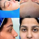 عمل جراحی بینی و پیکر تراشی،جشنواره تابستان تخفیف ۳۰٪