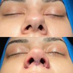 عمل جراحی بینی و پیکر تراشی،جشنواره تابستان تخفیف ۳۰٪